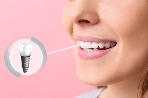 FAQs: Bone Graft For Dental Implants