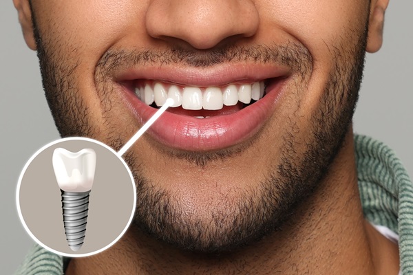 Avoiding Infection With Dental Implants