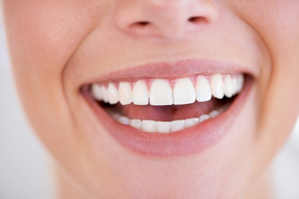 When Is An In Office Teeth Whitening Treament Recommended?