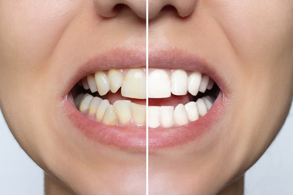 Professional Teeth Whitening Vs At Home Kits: What Works Best?