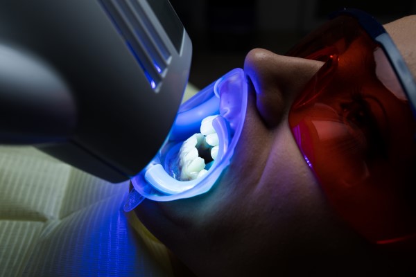 Teeth Whitening: In Office Vs At Home—Which Gives Better Results?
